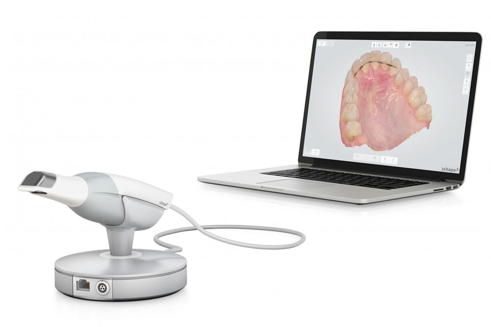 3D口腔内スキャナーで精密な型取り