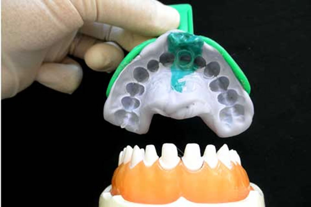 リハビリ用義歯で噛み合わせの修正
